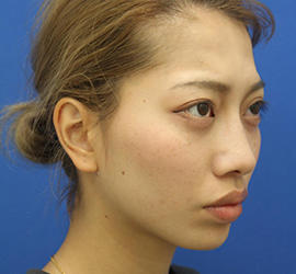 20代女性のシワ・たるみ After 症例写真