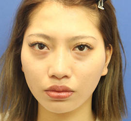 20代女性の3Dリポアイリフト  Before 症例写真