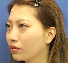 20代女性の3Dリポアイリフト  Before 症例写真