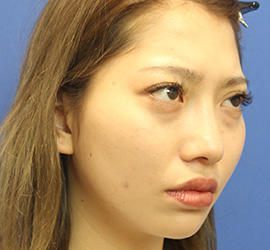 20代女性のシワ・たるみ Before 症例写真