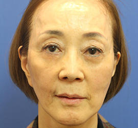 60代女性のヒアルロン酸骨格リフト After 症例写真