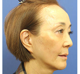 60代女性のヒアルロン酸骨格リフト After 症例写真