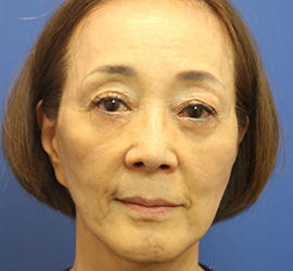 60代女性のヒアルロン酸骨格リフト Before 症例写真