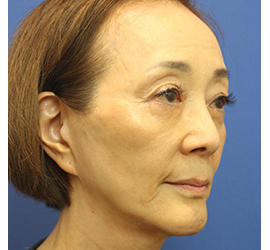 60代女性のヒアルロン酸骨格リフト Before 症例写真