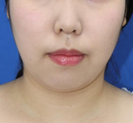 20代女性の顔の脂肪吸引 After 症例写真
