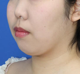 20代女性の顔の脂肪吸引  After 症例写真