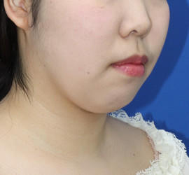 20代女性の顔の脂肪吸引  After 症例写真