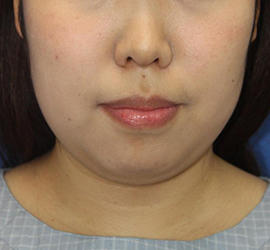 20代女性の顔の脂肪吸引 Before 症例写真