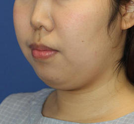 20代女性の顔の脂肪吸引  Before 症例写真