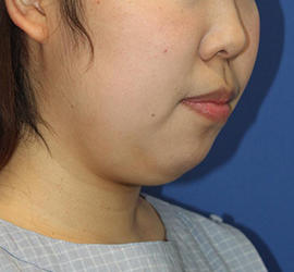 20代女性の顔の脂肪吸引  Before 症例写真