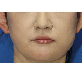 40代女性の顔の脂肪吸引  After 症例写真