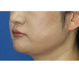 40代女性の顔の脂肪吸引  After 症例写真