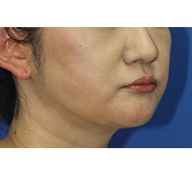 40代女性のシワ・たるみ After 症例写真