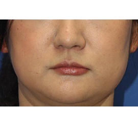 40代女性の顔の脂肪吸引  Before 症例写真
