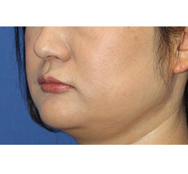 40代女性の顔の脂肪吸引  Before 症例写真