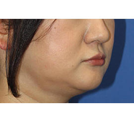 40代女性のシワ・たるみ Before 症例写真