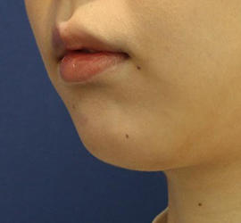 20代女性の唇・口元の整形 After 症例写真