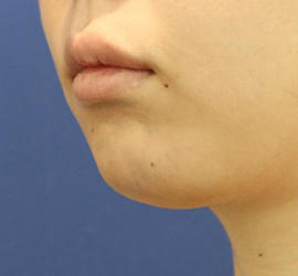 20代女性の唇・口元の整形 Before 症例写真