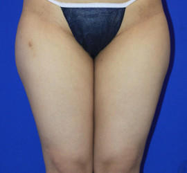 20代女性の脂肪吸引 Before 症例写真