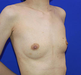 30代女性の豊胸バッグMotiva（モティバ） エルゴノミックス Before 症例写真