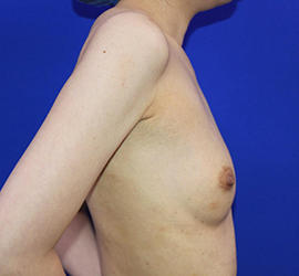 30代女性の豊胸バッグMotiva（モティバ） エルゴノミックス Before 症例写真