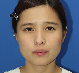 20代女性のシワ・たるみ After 症例写真