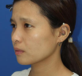 20代女性のメーラーファット除去 After 症例写真