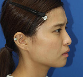 20代女性のメーラーファット除去 After 症例写真