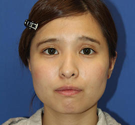 20代女性のシワ・たるみ Before 症例写真