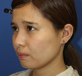 20代女性のメーラーファット除去 Before 症例写真