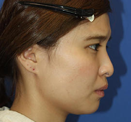 20代女性のメーラーファット除去 Before 症例写真