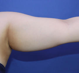 20代女性の脂肪吸引 Before 症例写真