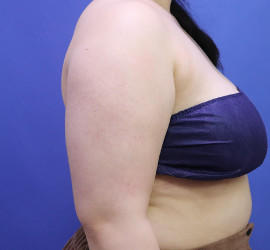 20代女性の脂肪吸引 Before 症例写真