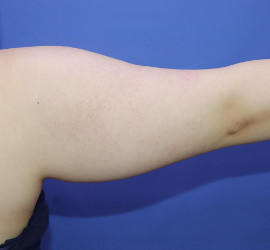 20代女性の脂肪吸引 Before 症例写真