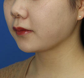 20代女性の顔の脂肪吸引  After 症例写真
