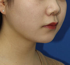 20代女性の顔の脂肪吸引 After 症例写真