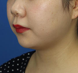 20代女性の顔の脂肪吸引  Before 症例写真