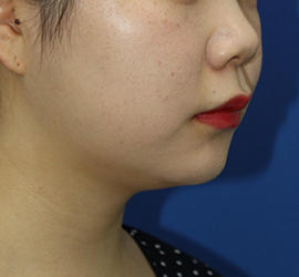 20代女性の顔の脂肪吸引 Before 症例写真