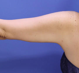 50代女性の脂肪吸引 After 症例写真