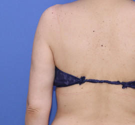 50代女性の脂肪吸引 After 症例写真