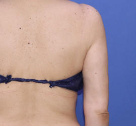 50代女性の脂肪吸引 After 症例写真