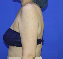 50代女性の脂肪吸引 Before 症例写真