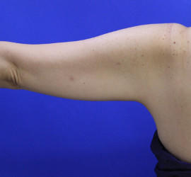 50代女性の脂肪吸引 Before 症例写真