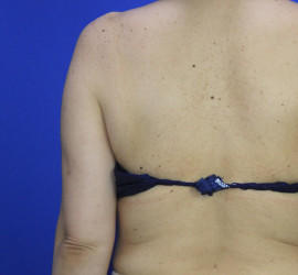 50代女性の脂肪吸引 Before 症例写真