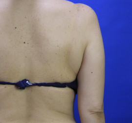 50代女性の脂肪吸引 Before 症例写真