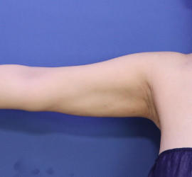 30代女性の脂肪吸引 After 症例写真