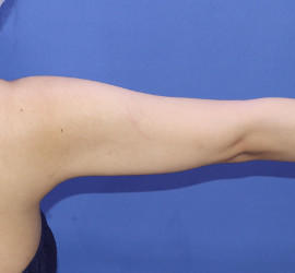 30代女性の脂肪吸引 After 症例写真