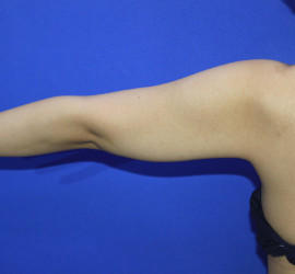 30代女性の脂肪吸引 Before 症例写真