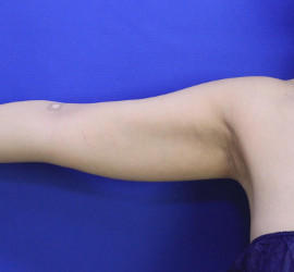 30代女性の脂肪吸引 Before 症例写真