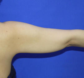 30代女性の脂肪吸引 Before 症例写真